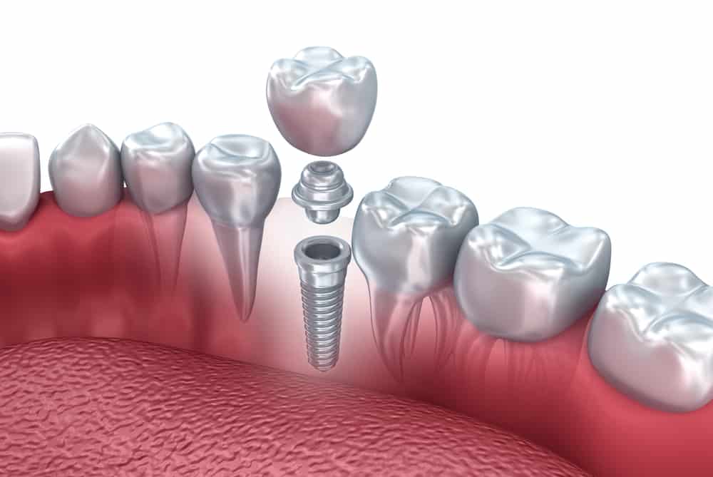 Are You Experiencing Movement Of Your Dental Implant?