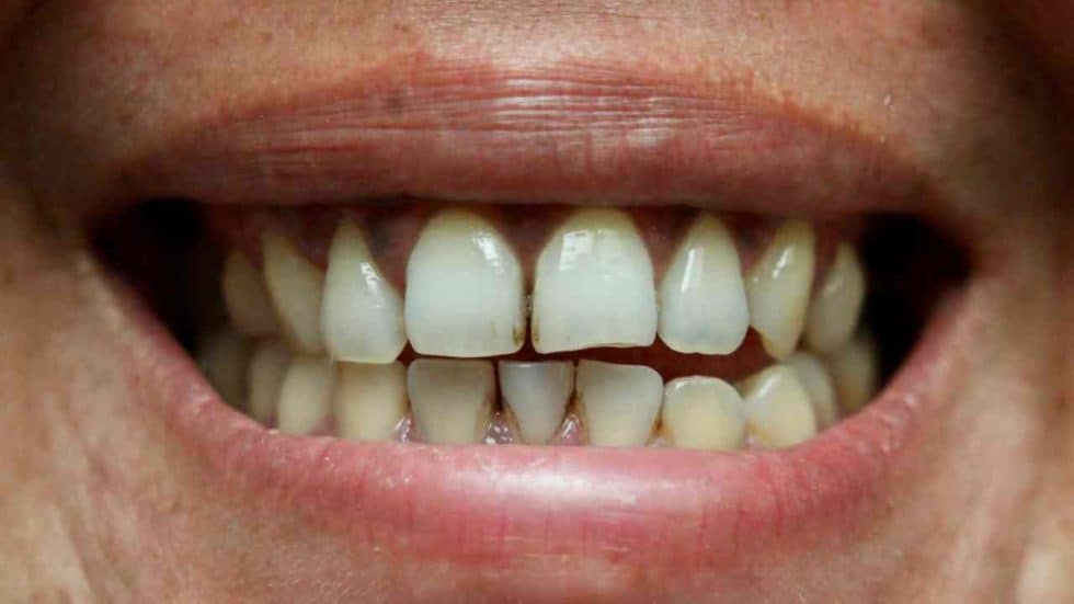 How To Remove Stains Between Teeth